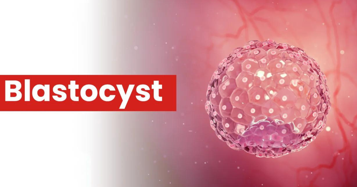 Best Blastocyst clinic in delhi